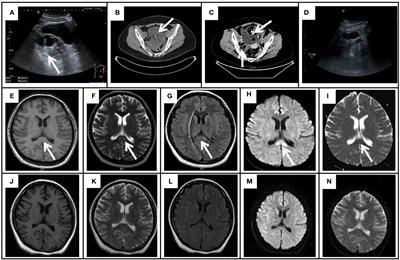 Frontiers Case Report Autoimmune Encephalitis With Multiple Auto